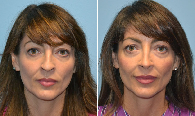 Male rhinoplasty before (left) and after (right), front view