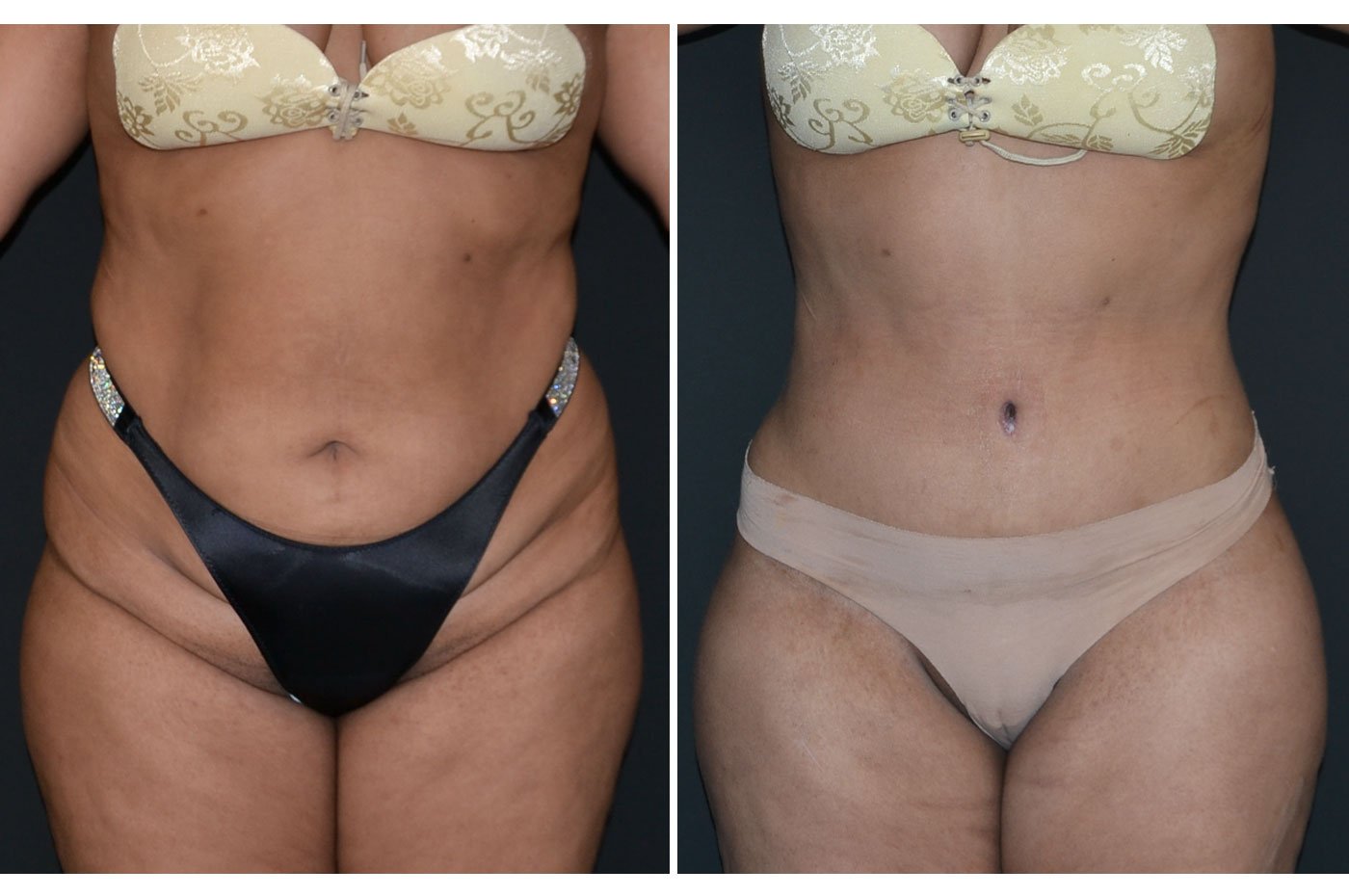 tummy tuck before (left) and after (right)