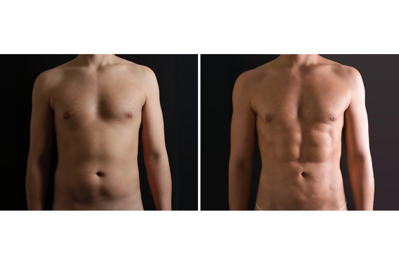 Male high definition liposuction before (left) and after (right), front view
