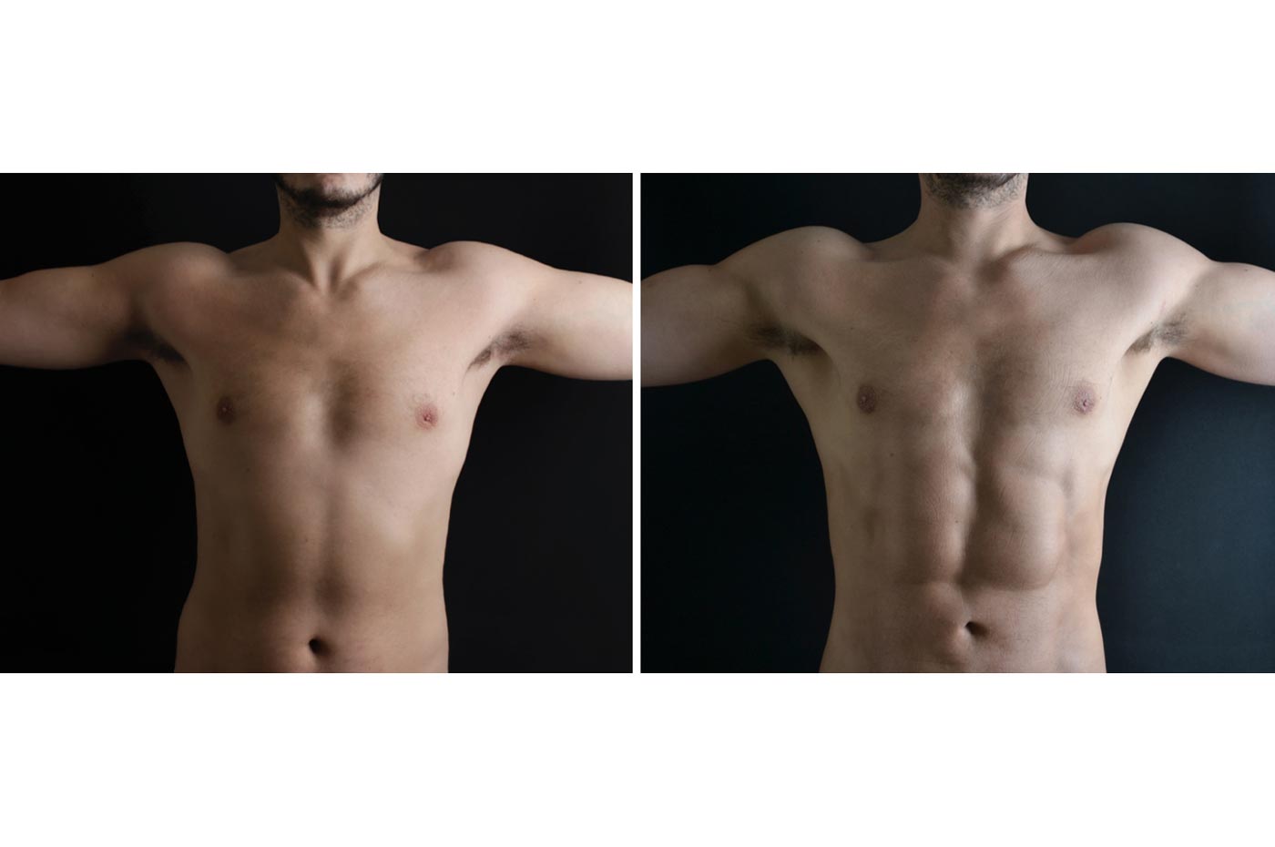 Male high definition liposuction before (left) and after (right), arms