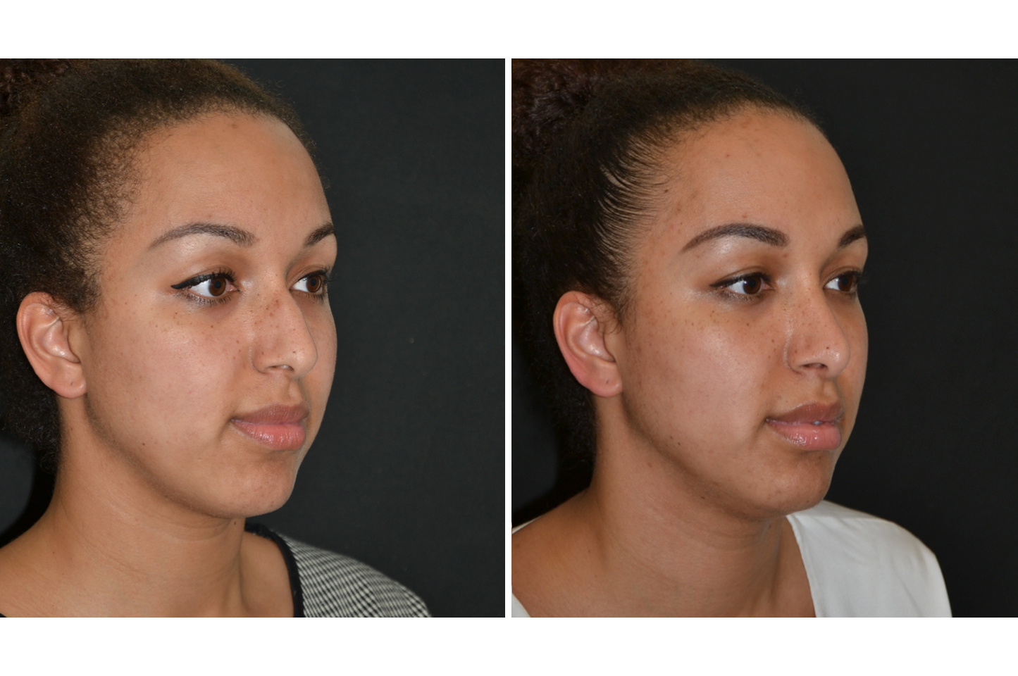 Male rhinoplasty before (left) and after (right), front view