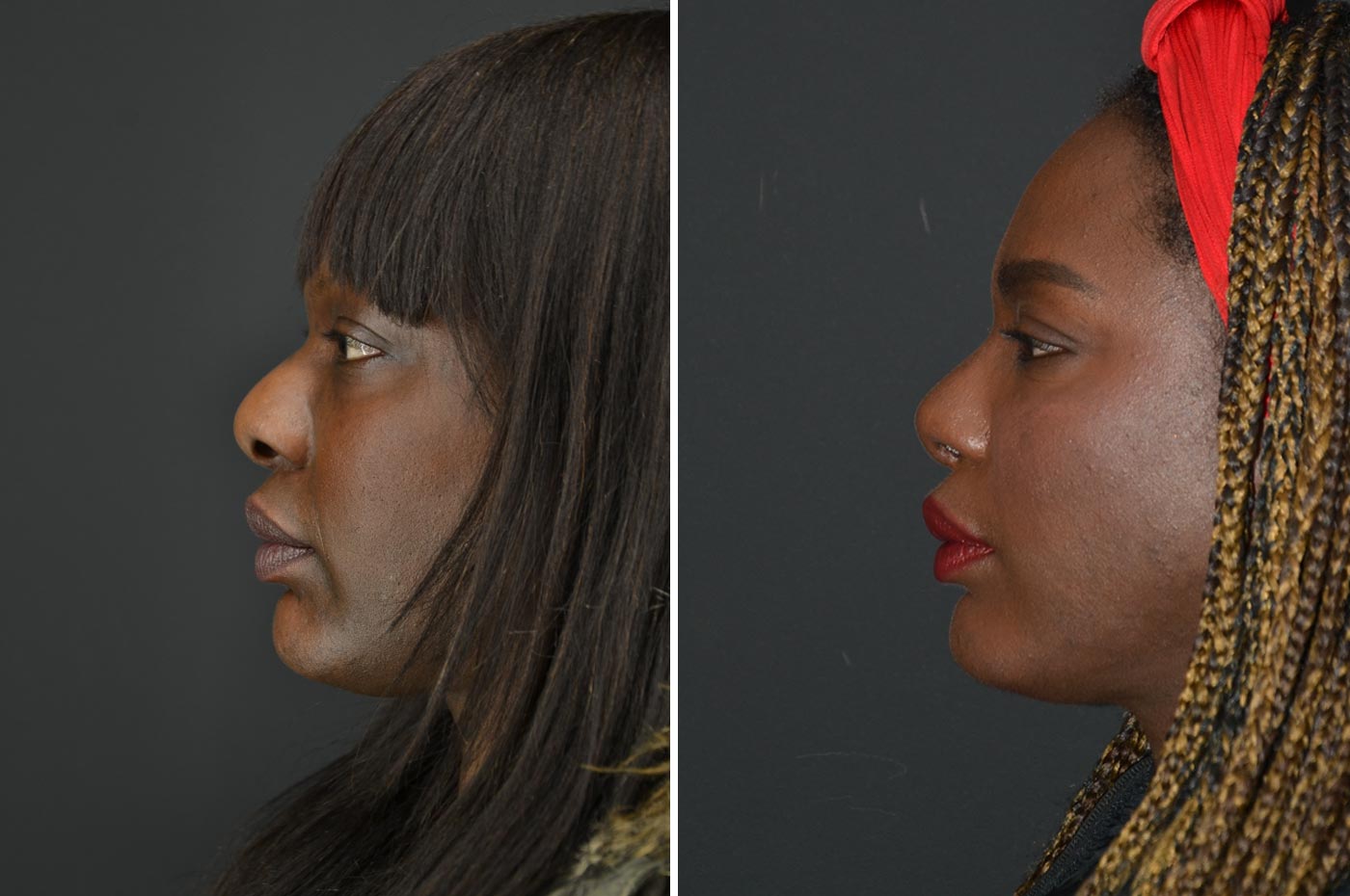 Male rhinoplasty before (left) and after (right), side view