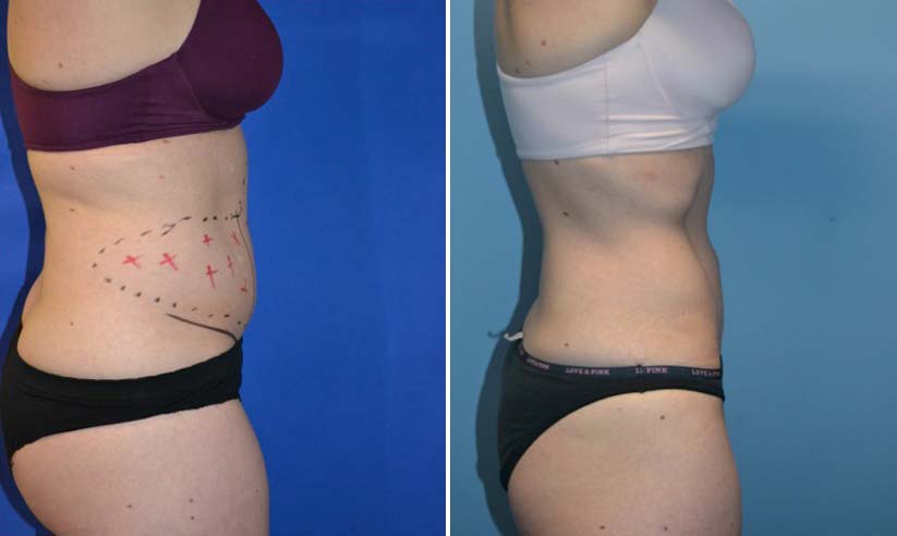 female liposuction before (left) and after (right), side view