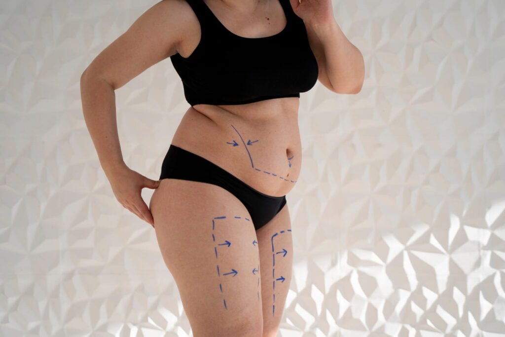A middle-aged woman who will undergo liposuction