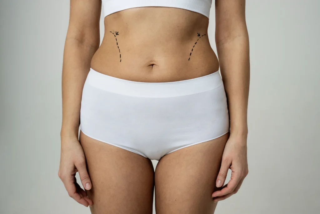 Plastic surgeon marking where liposuction scars may appear