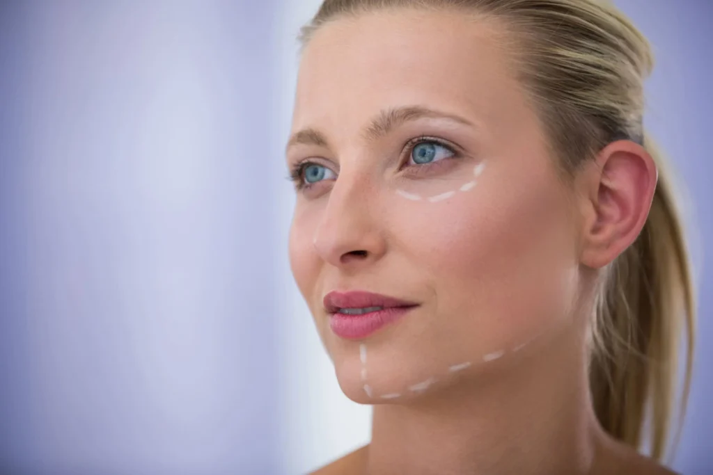 Woman with pdo thread lift marks