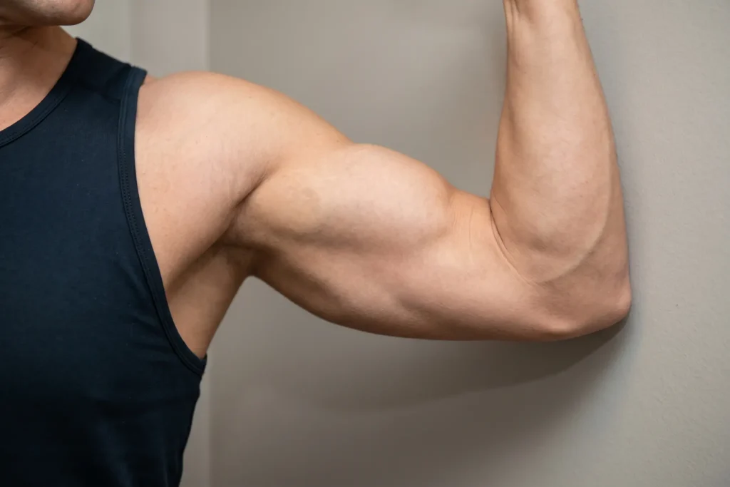 Toned upper arm showing HD liposuction muscle definition results