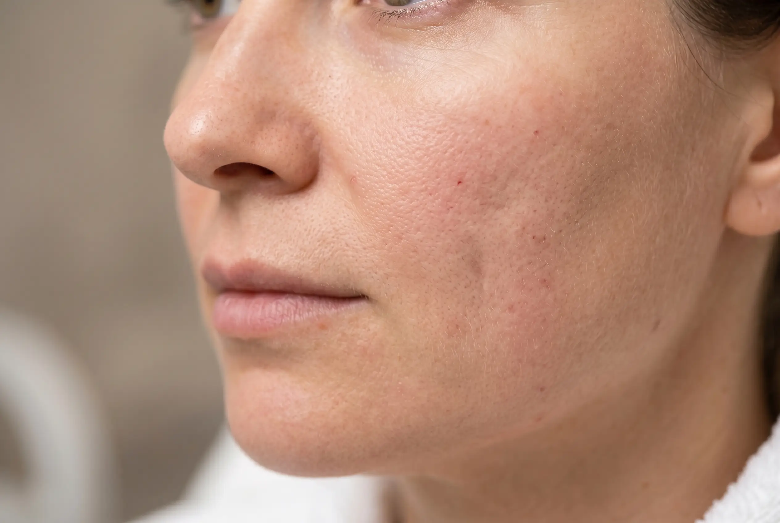 Close-up of mild PDO thread puckering as small dimples on a cheek after a thread lift