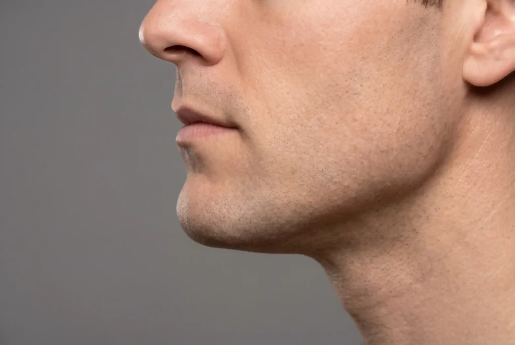 Jawline filler treatment target zones along the jaw angle and chin