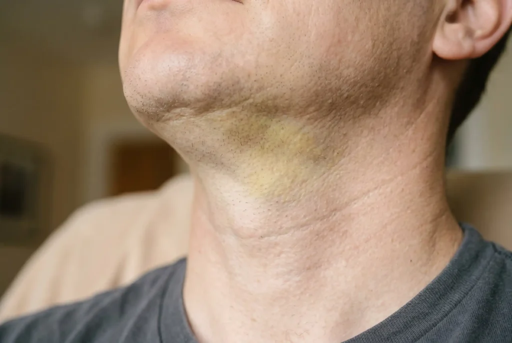 Bruising timeline showing fading discoloration after neck liposuction