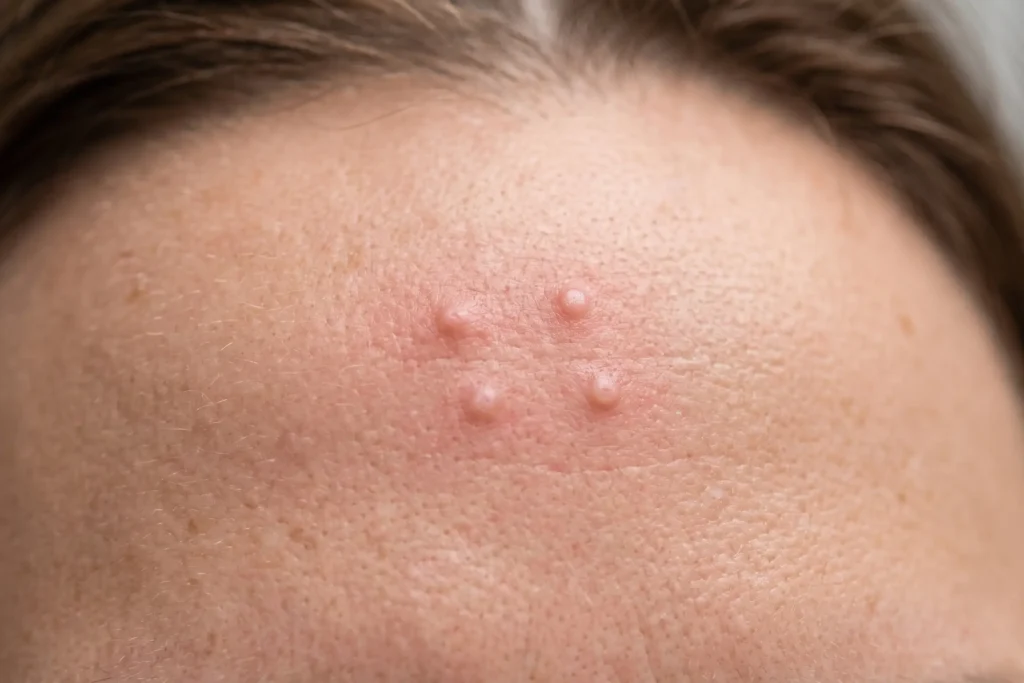 Photorealistic macro of subtle small raised bumps on a smooth adult forehead just after injection, slight redness, even soft lighting, realistic pores, neutral tone.
