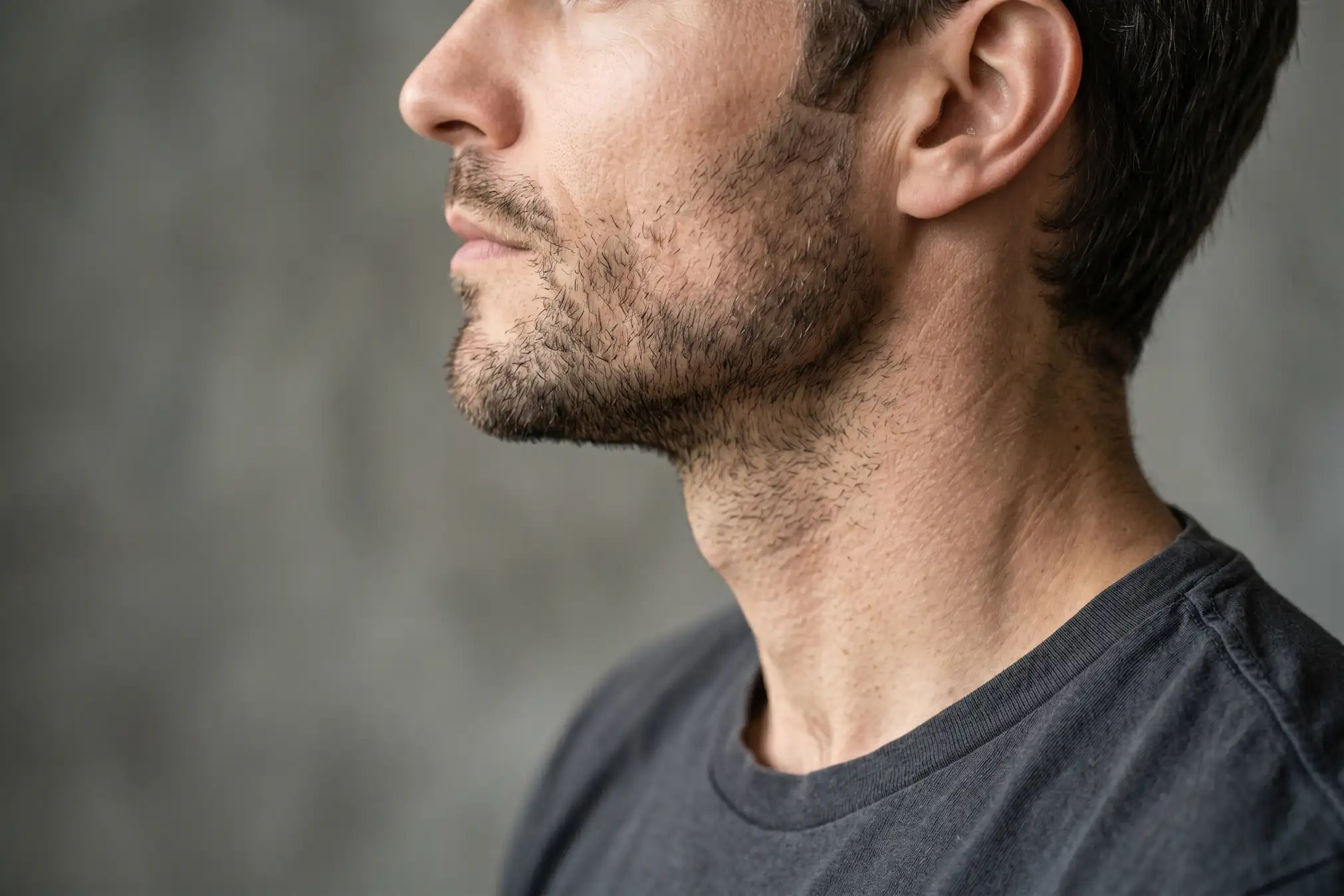Close-up profile of a defined jawline after jawline filler