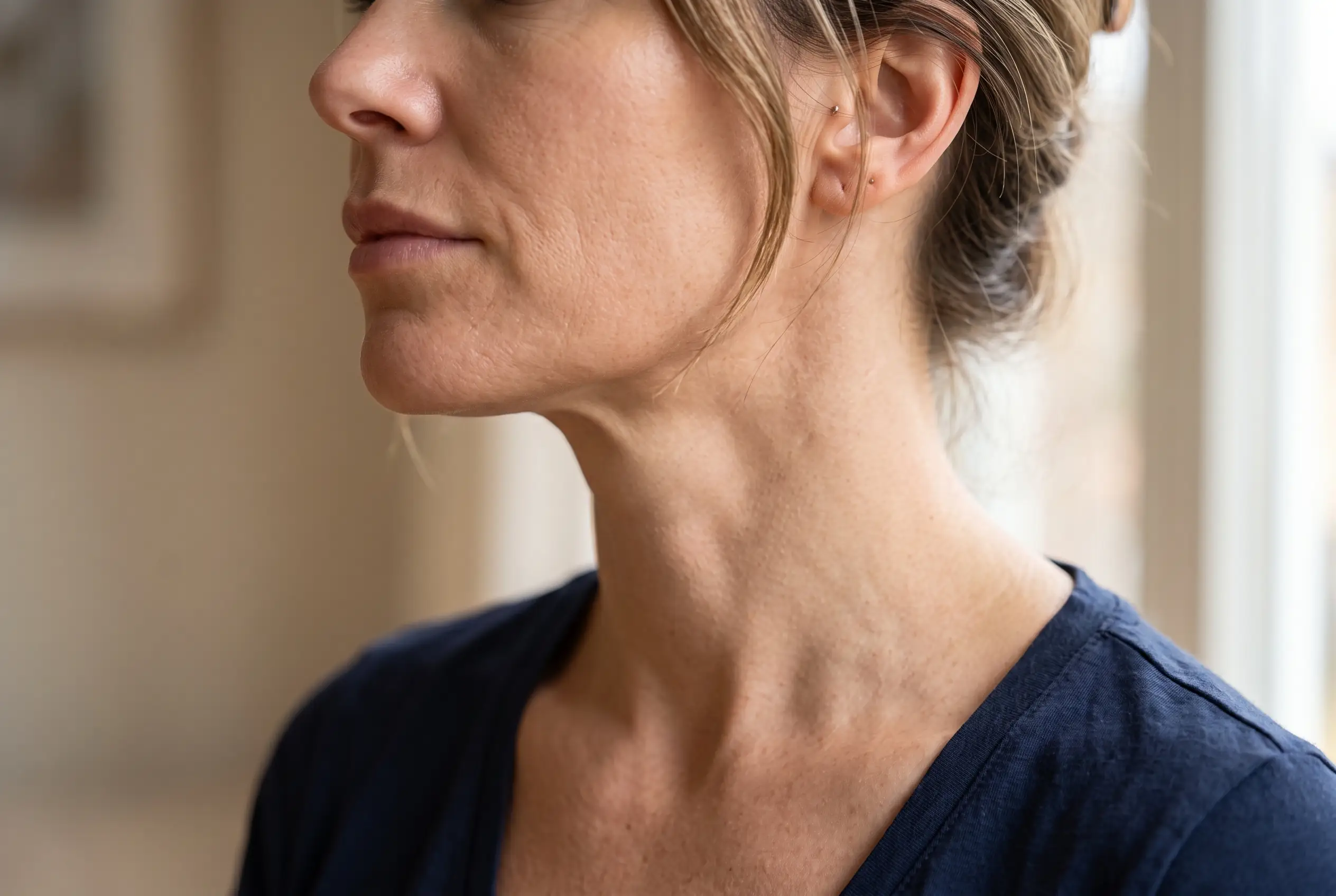Firm jawline after FaceTite radiofrequency skin tightening, side profile