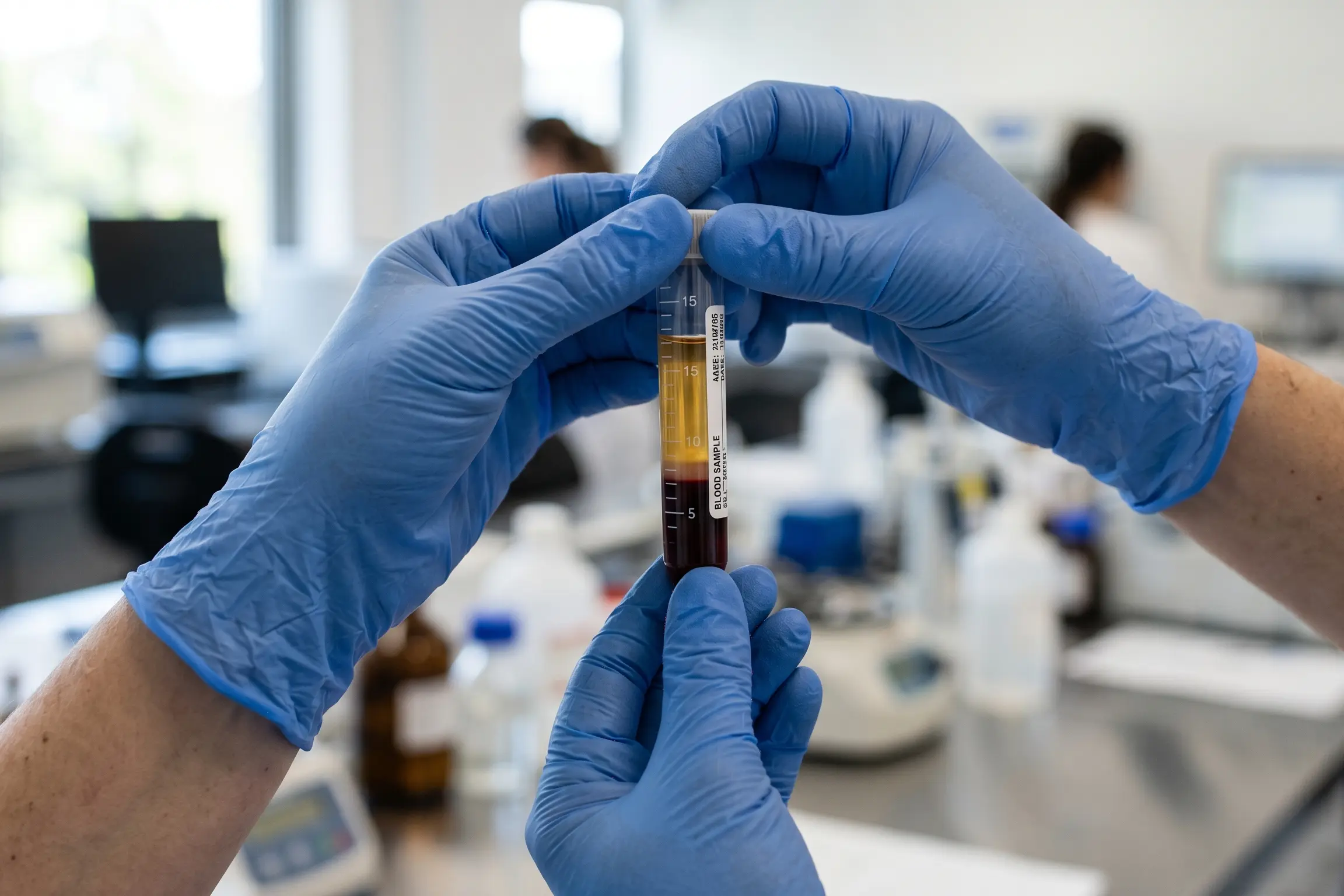 Separated platelet-rich plasma tube before a PRP injection at a Tampa clinic