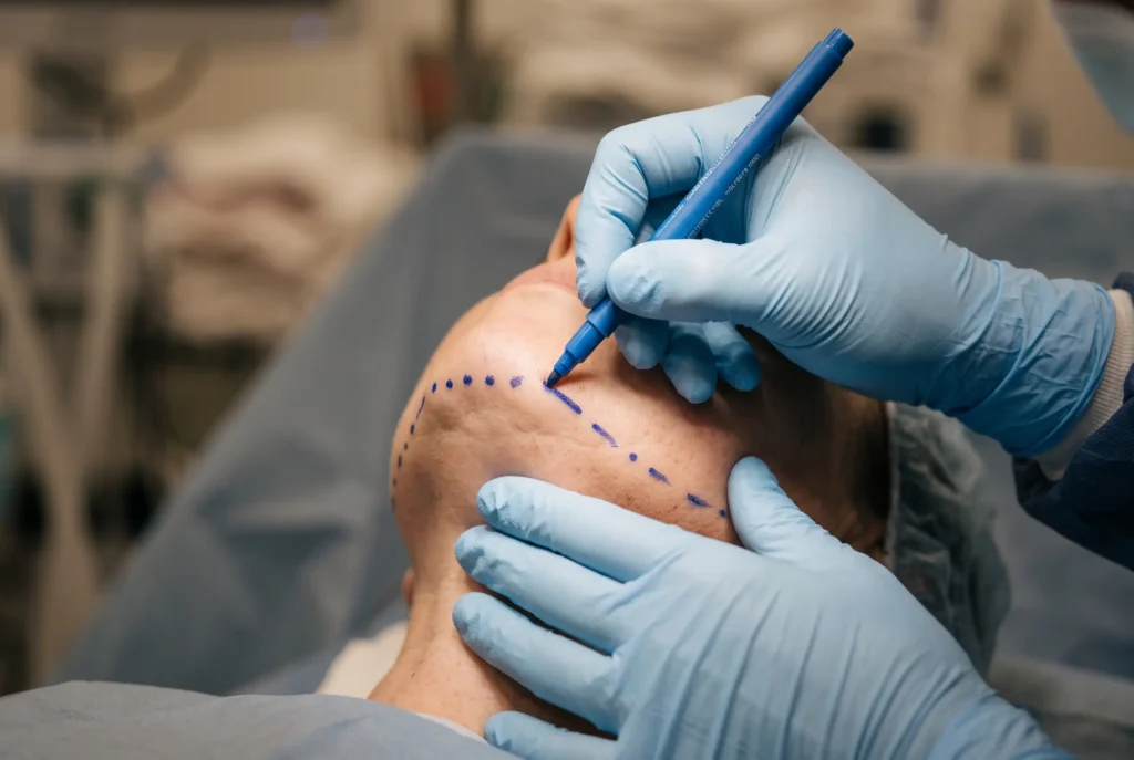 Surgeon marking the jawline before FaceTite in Downtown Tampa