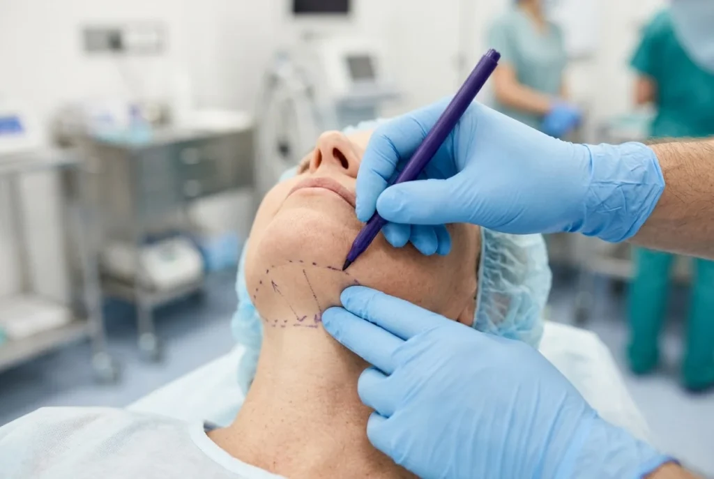 Surgeon marking the neck before neck liposuction under local anesthesia