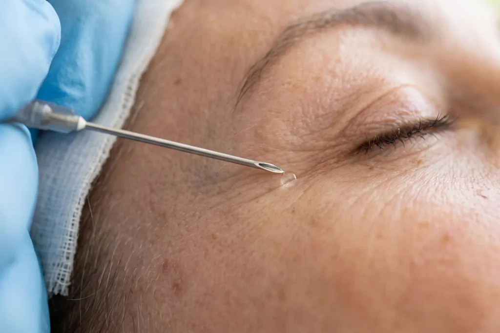 Close-up of shallow micro-injection technique used in baby Botox dosing