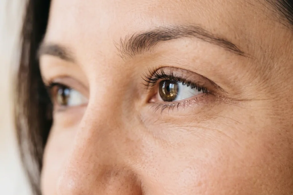 Close-up of the crow's-feet area showing where Botox around the eyes is placed
