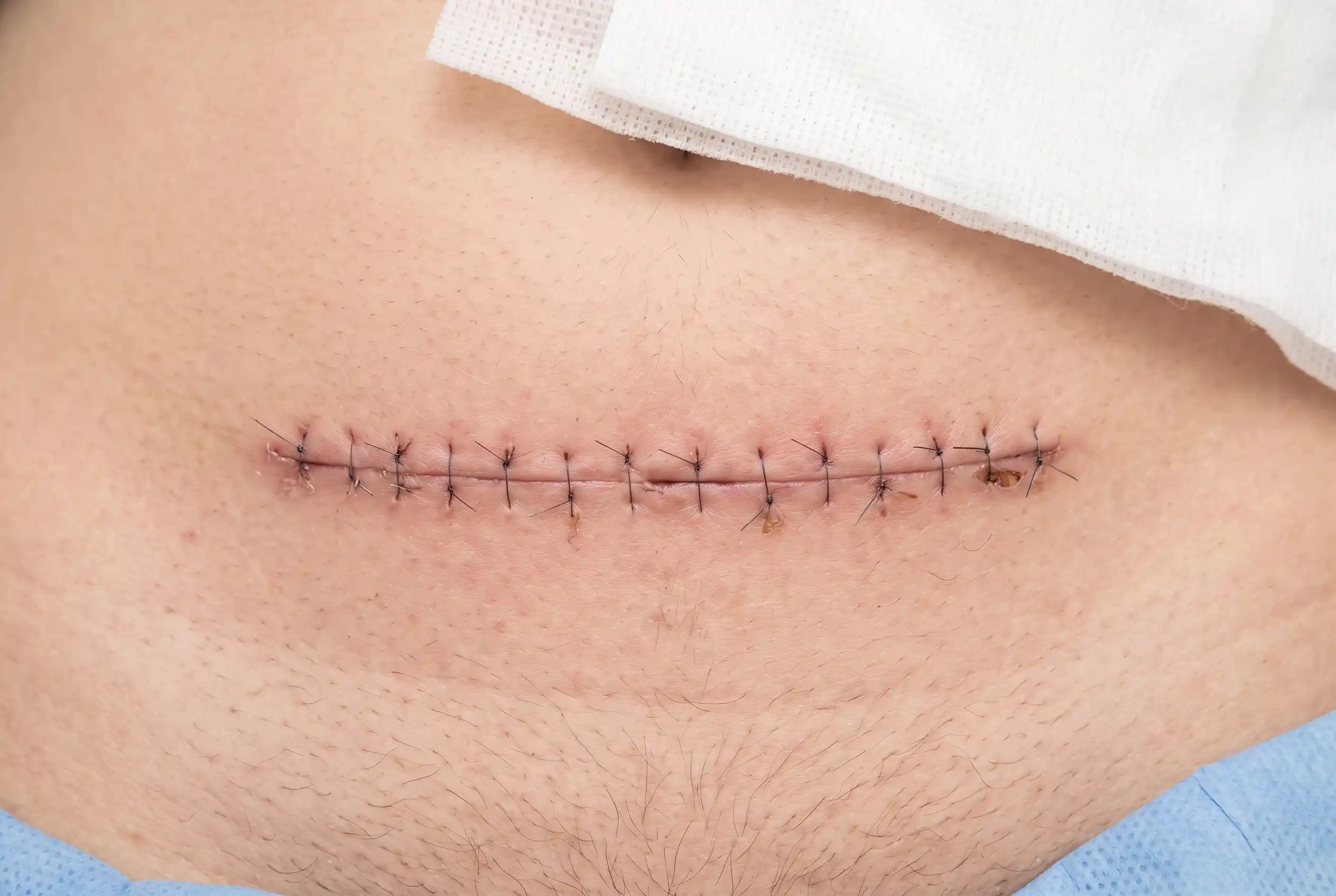 Close up of a healed lower abdominal incision two weeks after a tummy tuck