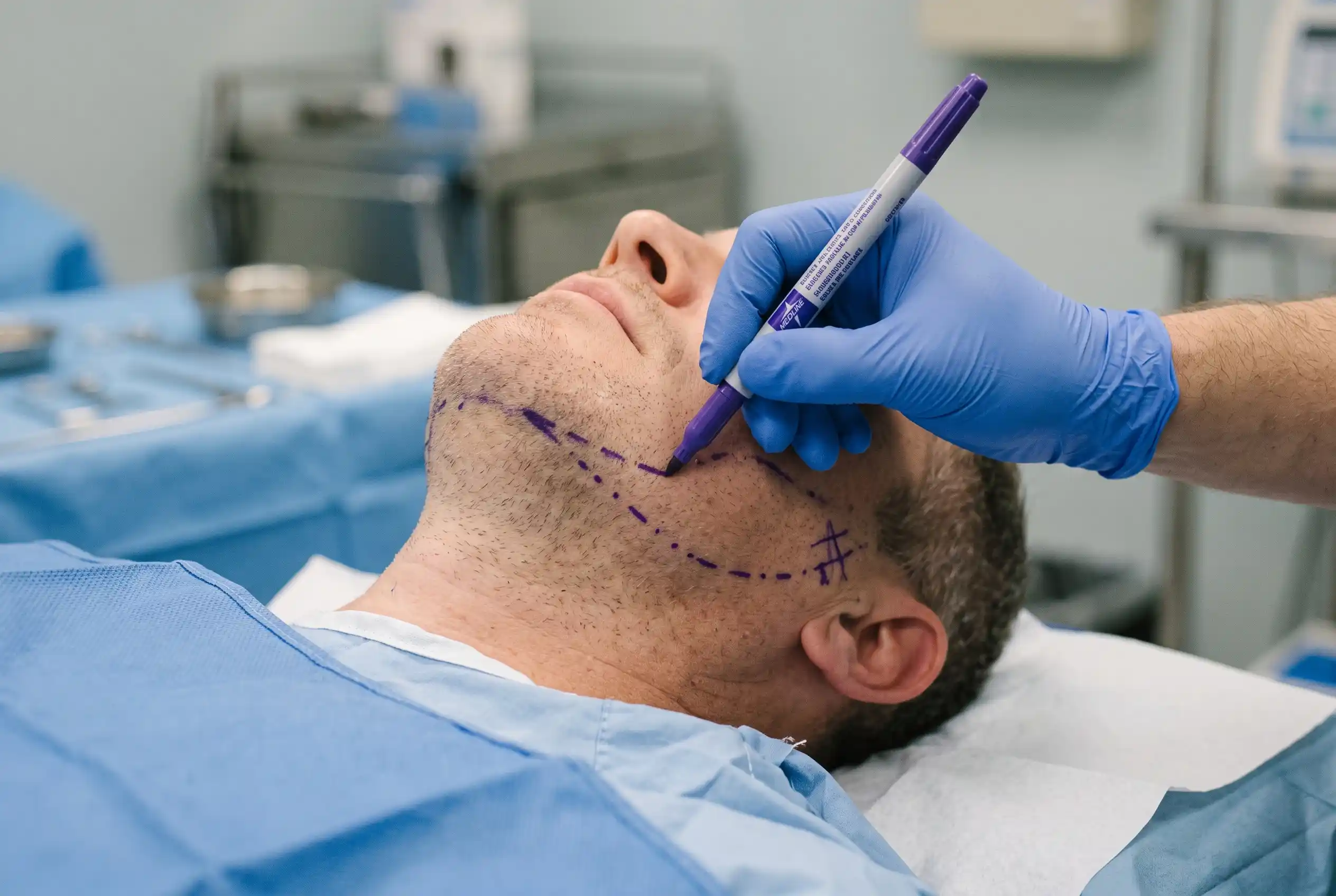 Provider marking lift vectors on the lower face before placing PDO threads