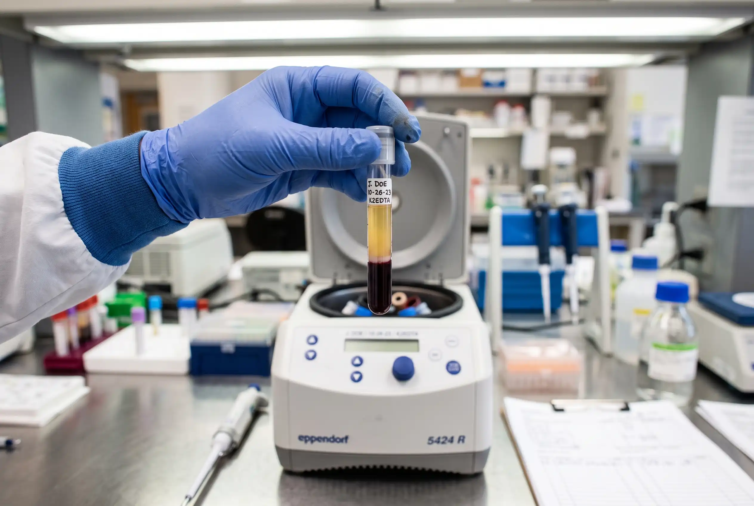 Separated blood tube showing the plasma layer used in PRP hair loss treatment