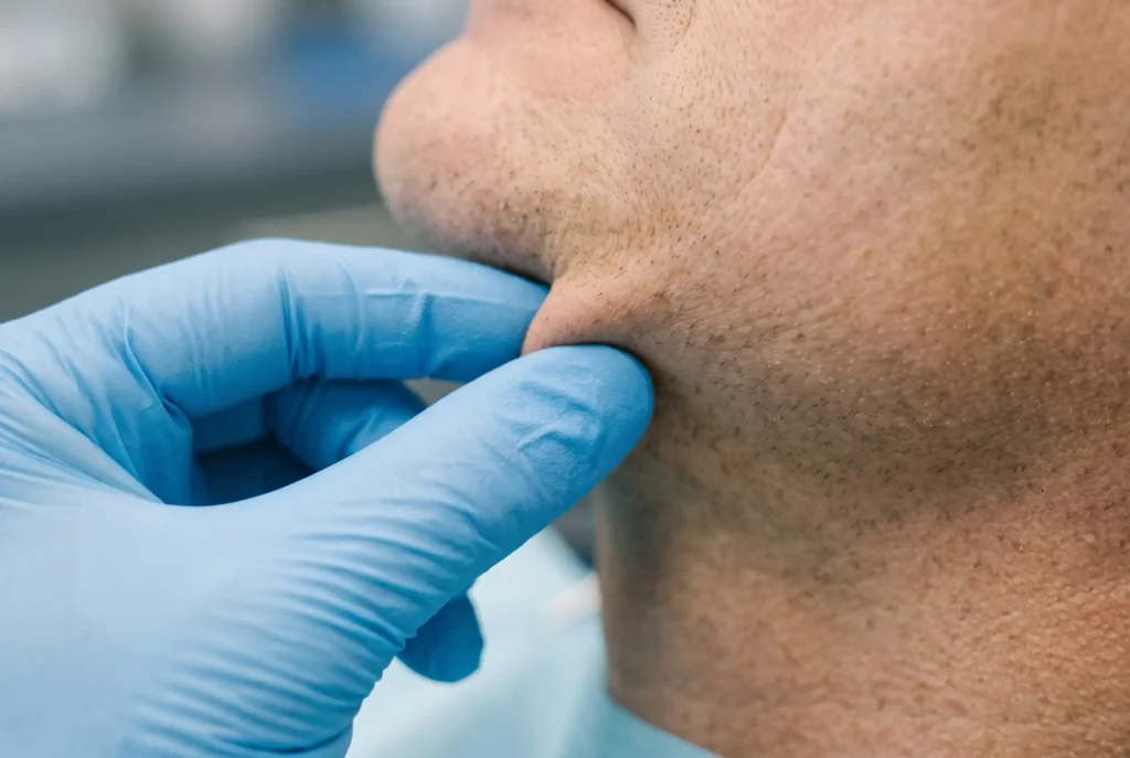 Skin elasticity pinch test at the jawline before FaceTite in Tampa