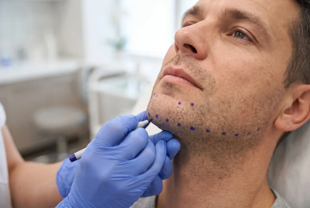 Injection points marked along the chin and jaw for jawline filler placement