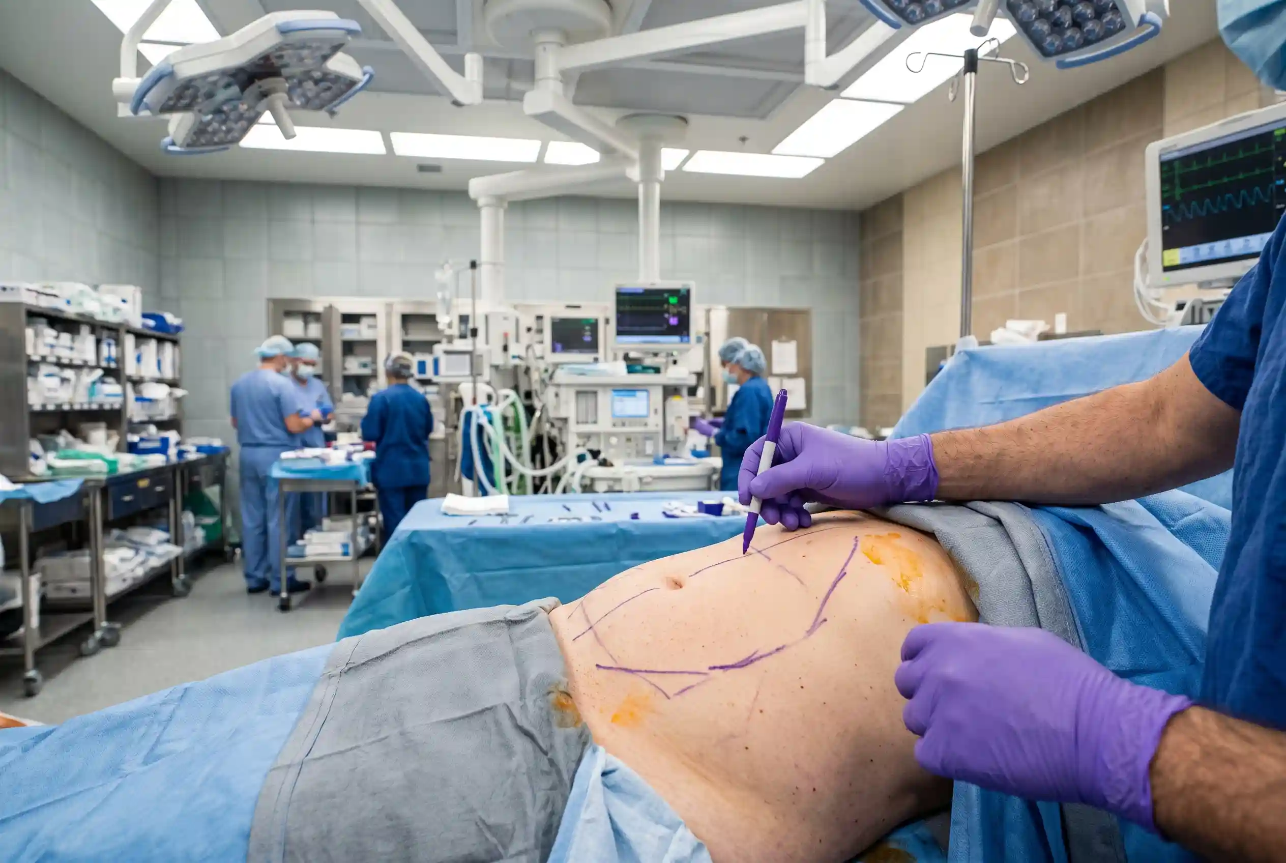 Surgeon mapping muscle borders before a natural-looking tummy tuck in Tampa