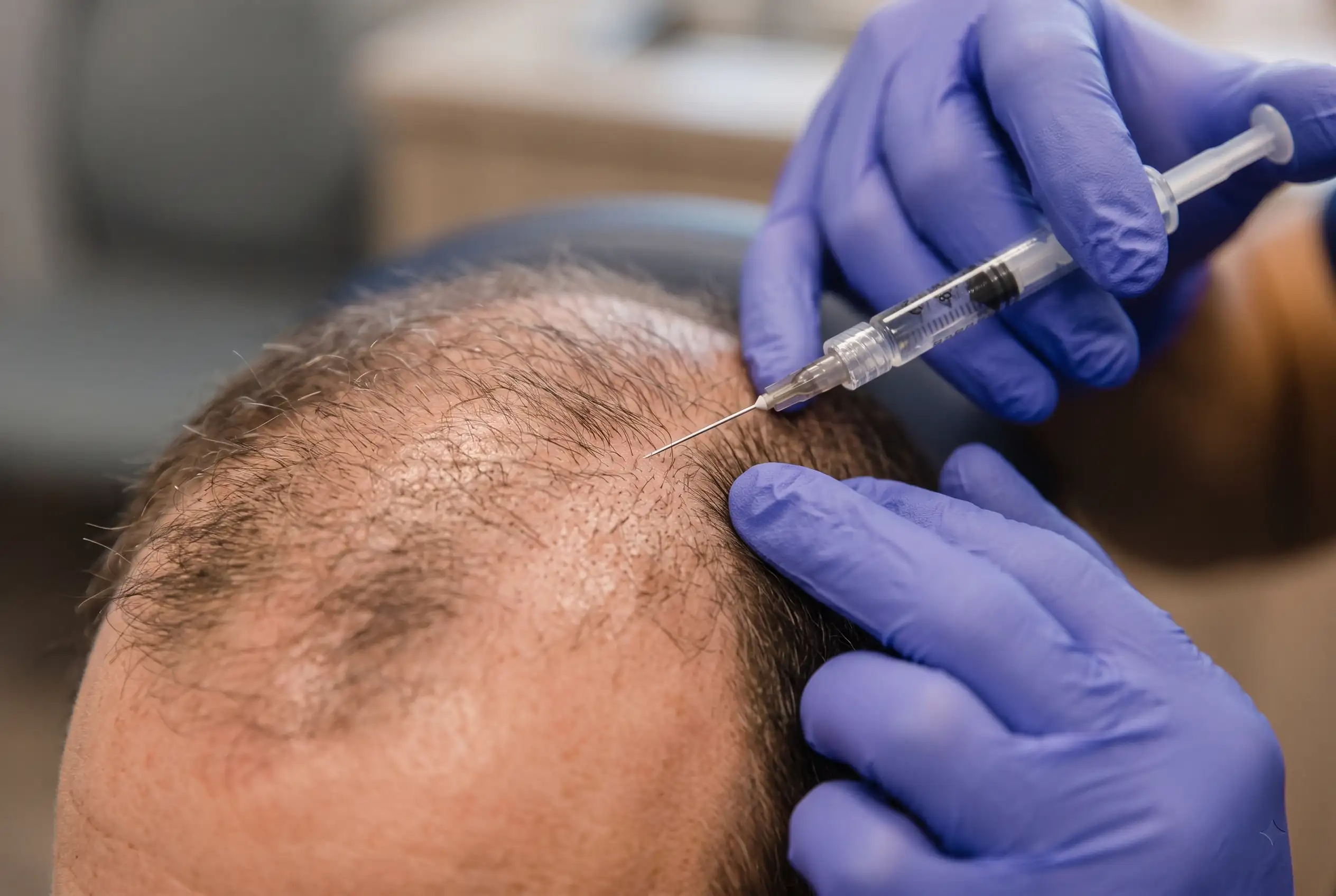 PRP scalp injection across a thinning crown for hair growth