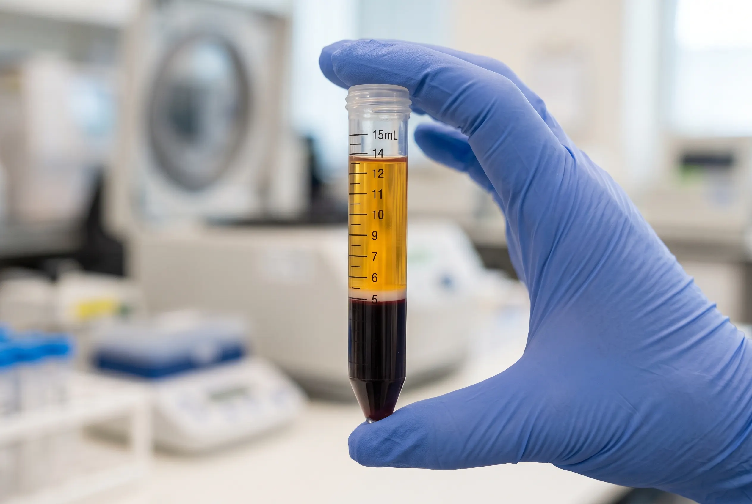 Centrifuged tube of platelet-rich plasma prepared before under-eye PRP treatment