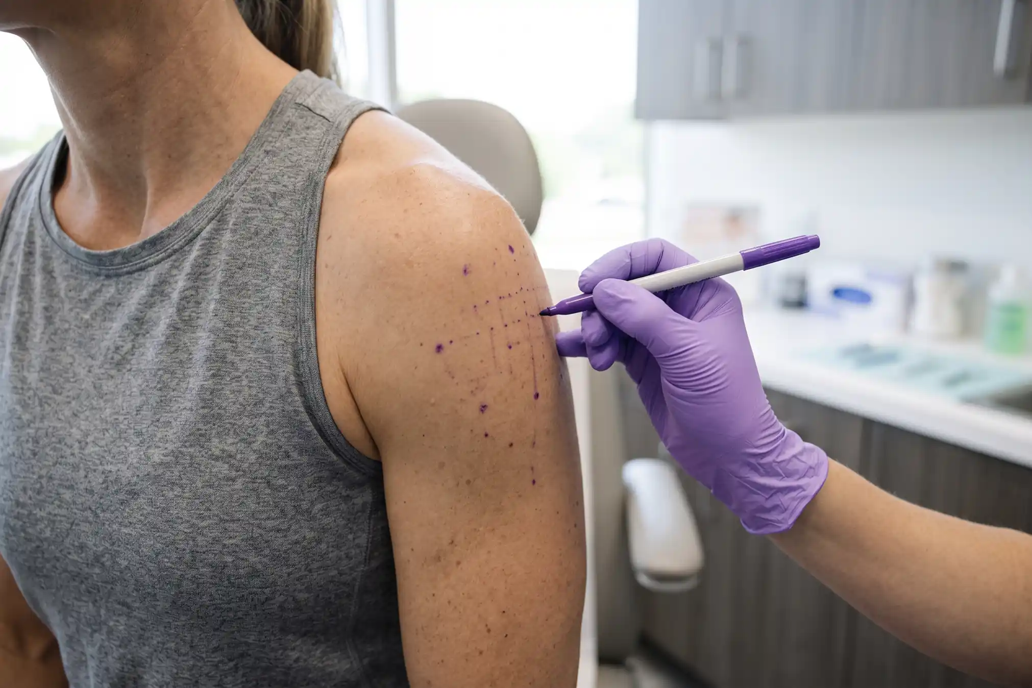 minor-bruising-a-common-arm-botox-side-effect