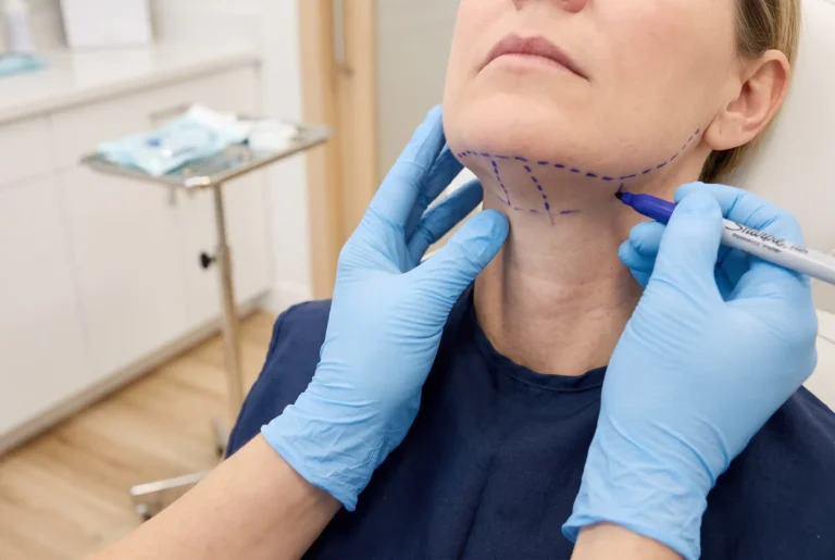 Provider marking the jawline before FaceTite with neck liposuction in a Tampa treatment room