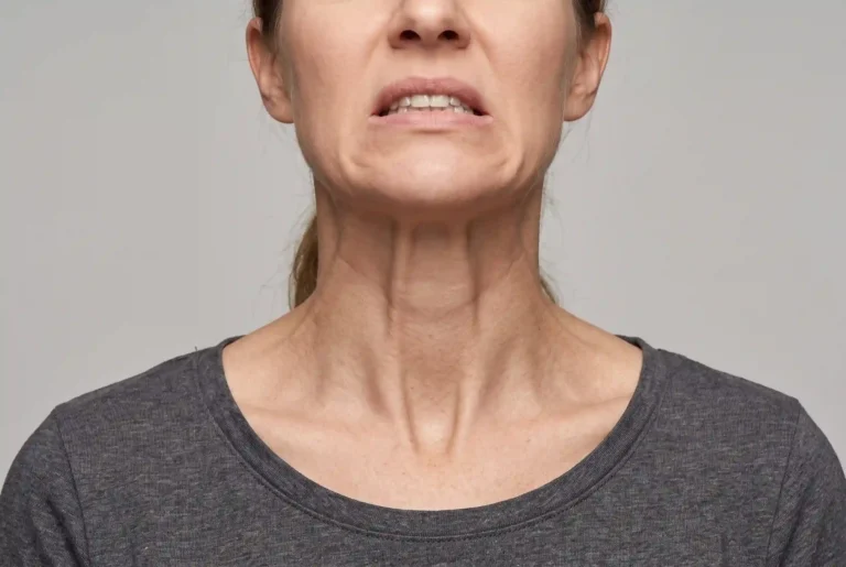 Close-up of vertical platysmal bands on the neck during a grimace, a common cause of a soft jawline
