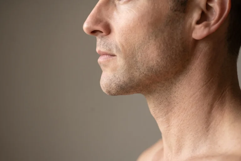 Defined male jawline and neck profile after neck liposuction near Bradenton