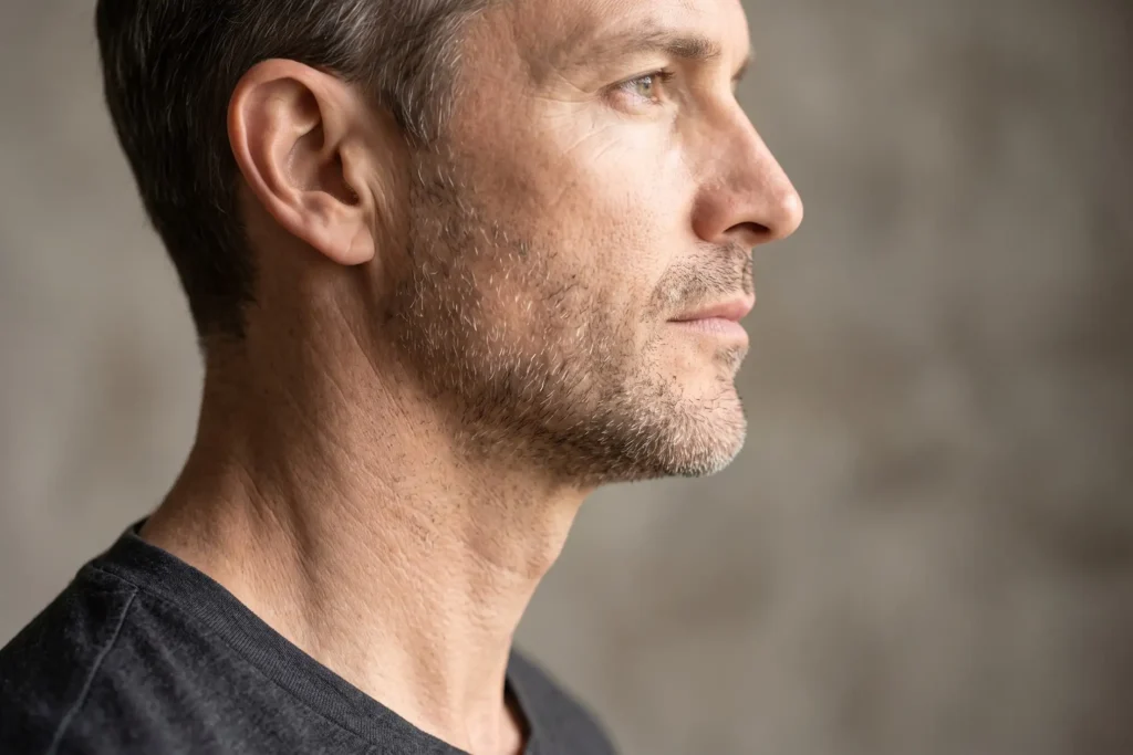 Defined male jawline and neck profile after neck liposuction near Sarasota