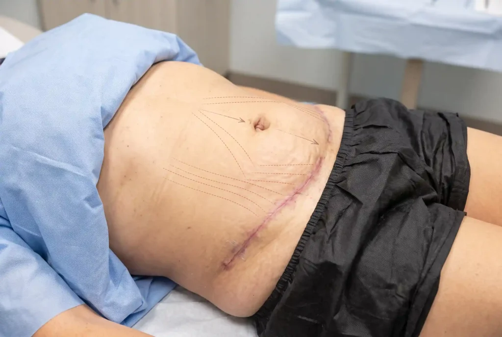 Where new stretch marks can form after a tummy tuck from skin tension