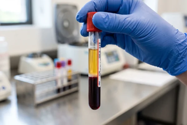 Centrifuged tube showing platelet-rich plasma layer used in PRP hair treatment