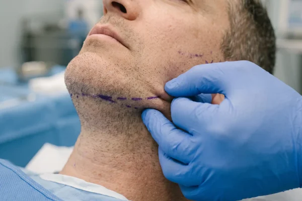 Clinician performing a skin recoil check along the jawline before a thread lift assessment