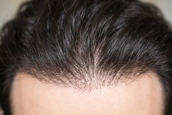 Close-up of a healthy hairline illustrating GHK-Cu peptide for hair growth support