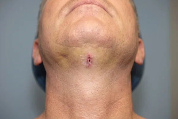 Close-up of chin and neck swelling two days after neck lipo surgery