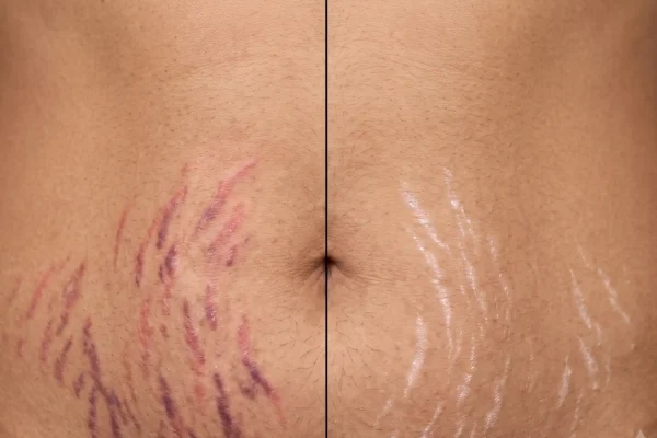 Fresh pink stretch marks compared with mature white stretch marks