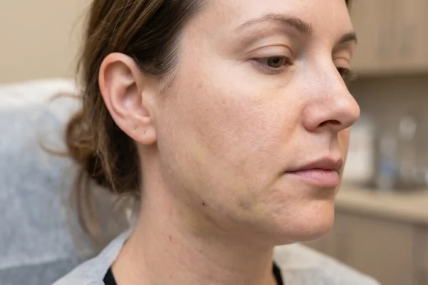 Mild bruising on the cheek showing why alcohol after a thread lift can worsen recovery