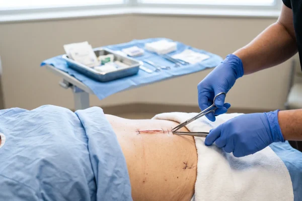 Nurse removing external stitches from a tummy tuck incision at a follow up visit