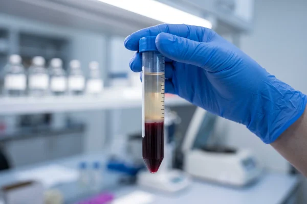 Separated platelet layer in a centrifuge tube prepared for PRP hair loss injections