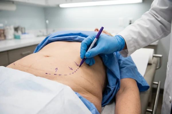 Surgeon assessing a good tummy tuck candidate during a body contouring consult