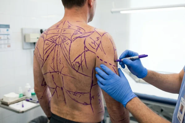 Surgeon marking arms and back for a combined HD liposuction session
