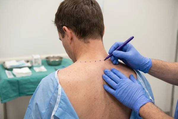 Clinician mapping injection points along the upper trapezius before treatment