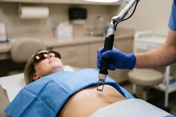 Fractional laser treatment being applied to abdominal stretch marks
