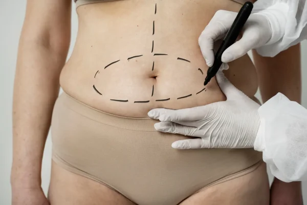 Plastic surgeon marking a patient with pen before plastic surgery
