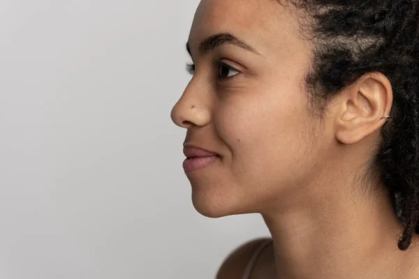 Side profile of a woman after getting jawline fillers